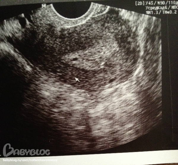 Эндометрий при переносе эмбриона. УЗИ плодное яйцо в матке 3 недели. Эндометрий на УЗИ на ранних сроках.