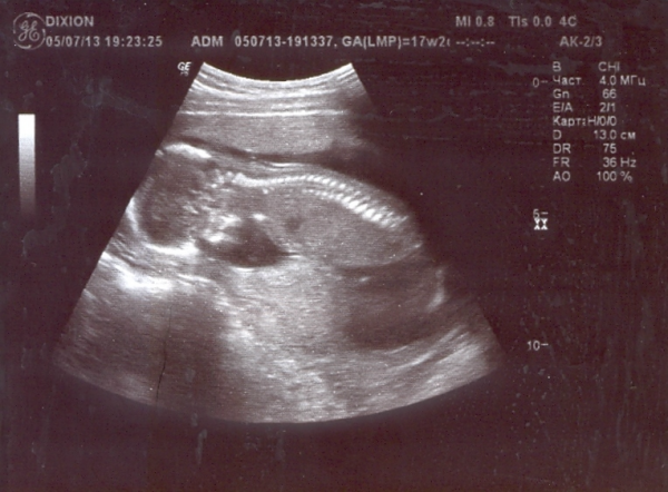 17 неделя часто. УЗИ ребенка на 17 неделе беременности. УЗИ плода 17 недель беременности. Фото УЗИ беременности 16-17 недель. УЗИ ребенка 17 недель УЗИ.
