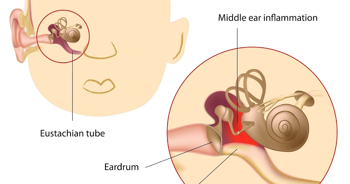 Симптомы отита у ребенка. Острый средний отит у детей.