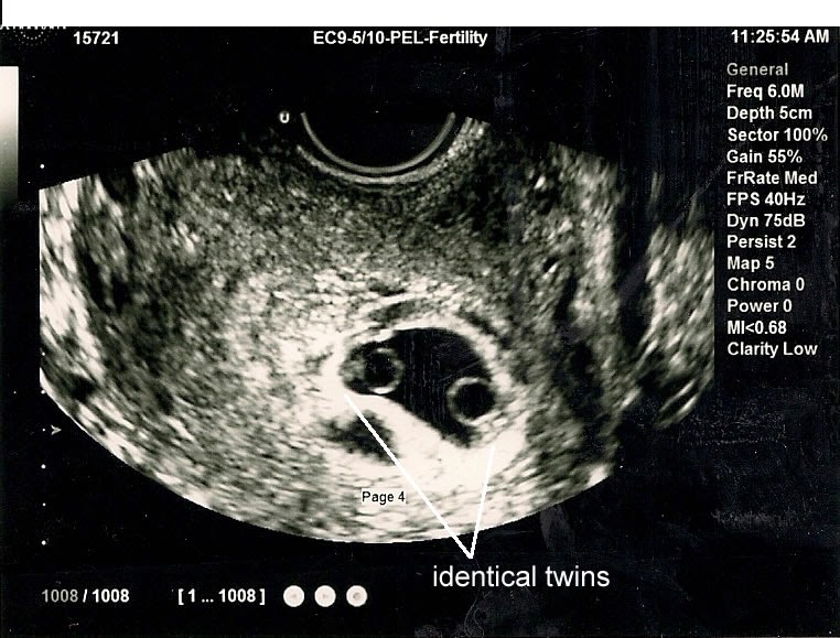 6 недель в минутах. Многоплодная беременность УЗИ 6 недель. УЗИ 6 недель беременности двойня однояйцевые. Однояйцевая двойня на УЗИ 6 недель. УЗИ 7 недель беременности двойня.