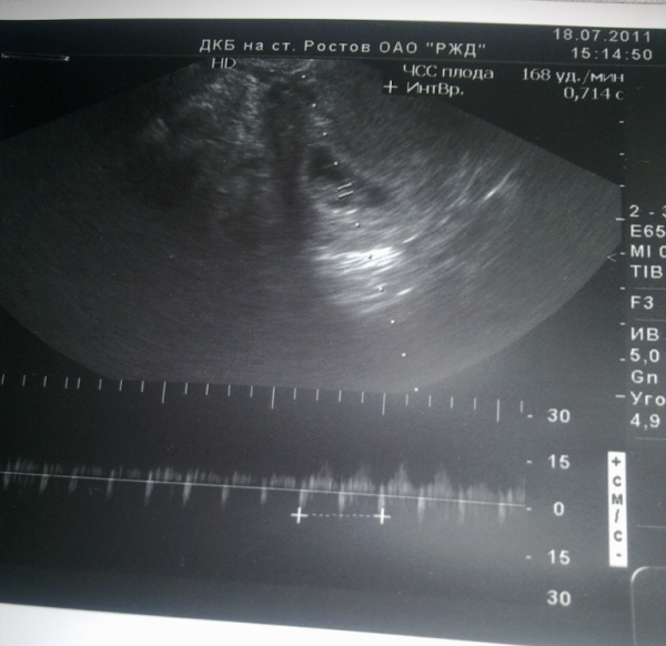8 недель нет сердцебиения. УЗИ 9 недель беременности. УЗИ ребенка 9 недель беременности фото. УЗИ на 9 недели отзывы.