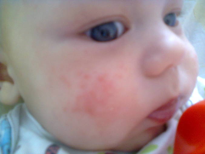 Аллергия на банан у ребенка фото