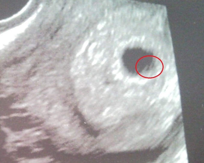 Когда виден эмбрион в плодном яйце. Желточный мешок на 5 неделе беременности на УЗИ. Плодное яйцо 16мм,эмбрион 6мм. УЗИ 6 недель беременности желточный мешок.
