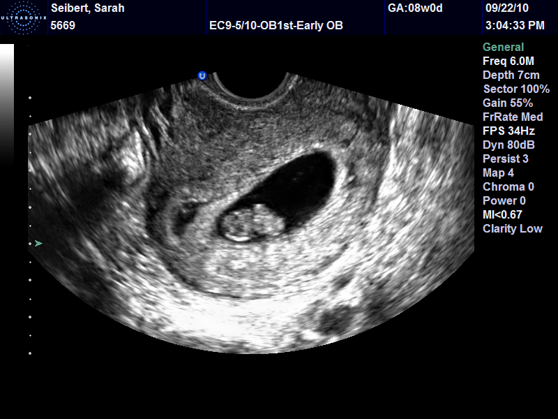 Как выглядит эмбрион на 7 неделе беременности фото узи