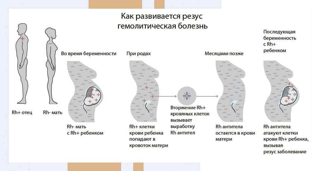 Нулевка беременным