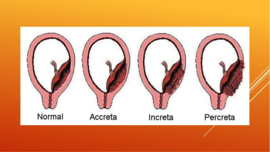 Врастание плаценты классификация. Центральное предлежание плаценты.