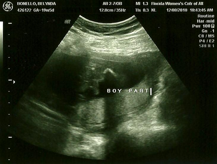Фото узи 21 неделя беременности девочка