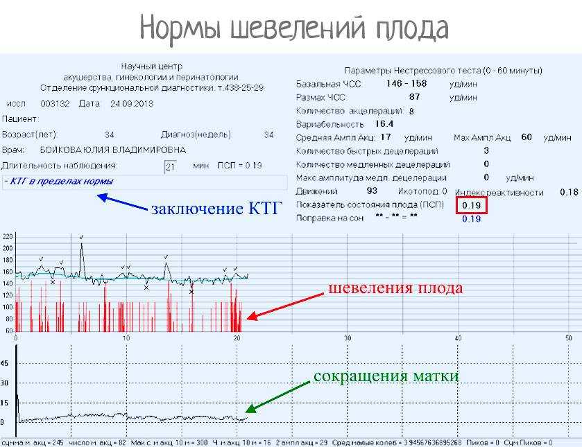 Ктг сколько. КТГ В норме при беременности на 25 неделе. Норма шевелений плода по КТГ. Норма шевелений плода при КТГ. Шевеления на КТГ.