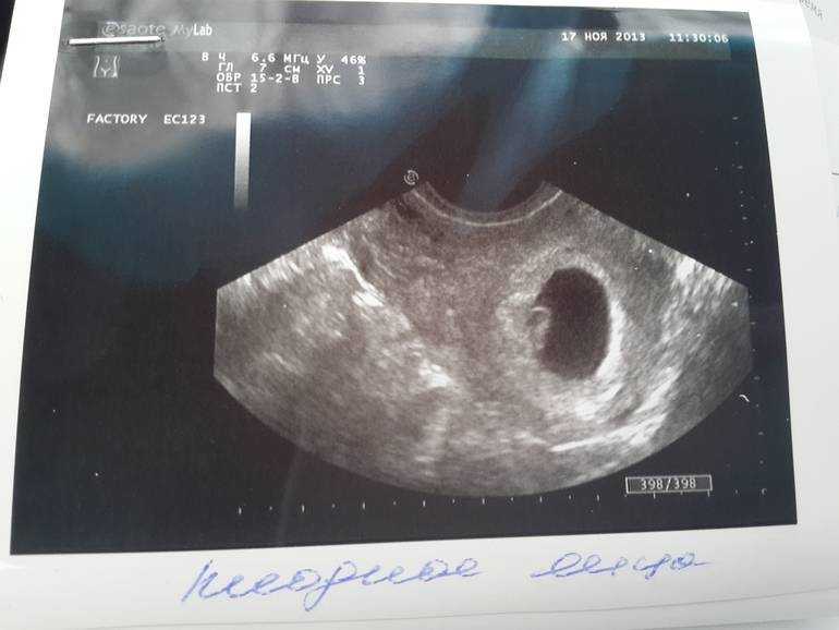 Не видно эмбрион на 5 неделе беременности
