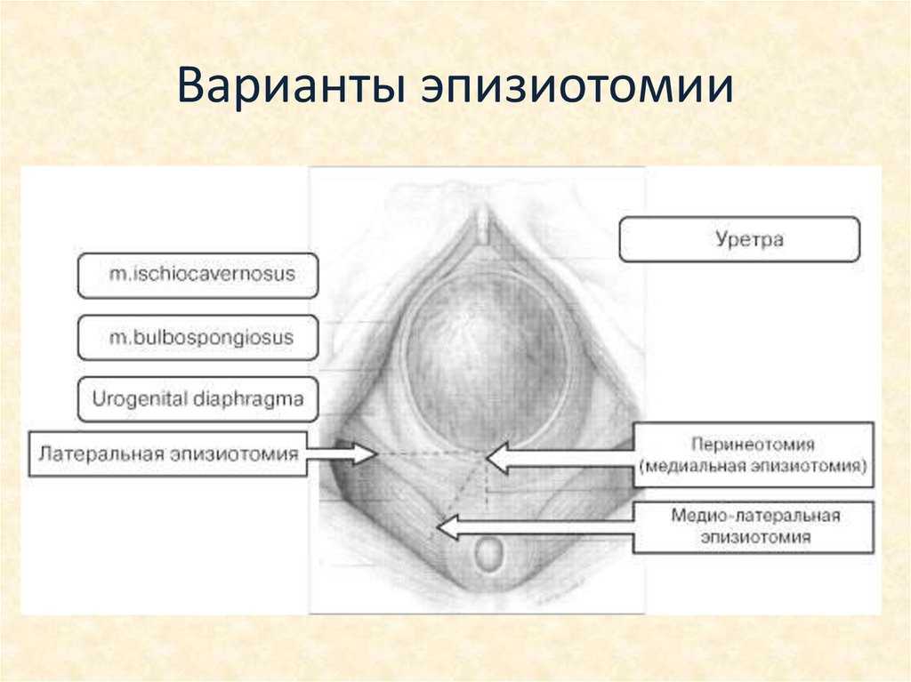 Эпизиотомия. Разрез промежности эпизиотомия. Латеральная эпизиотомия. Срединолотеральнаяэпизиотомия. Срединно латеральная эпизиотомия.