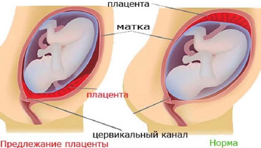 Ребенок расположен справа. Предлежание плаценты. Низкое расположение плаценты. Шеечное предлежание плаценты. Предлежание плаценты и низкая плацентация.