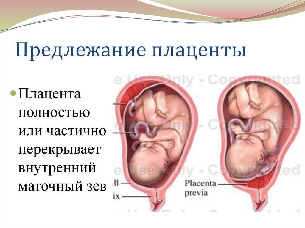 Предлежание плаценты фото