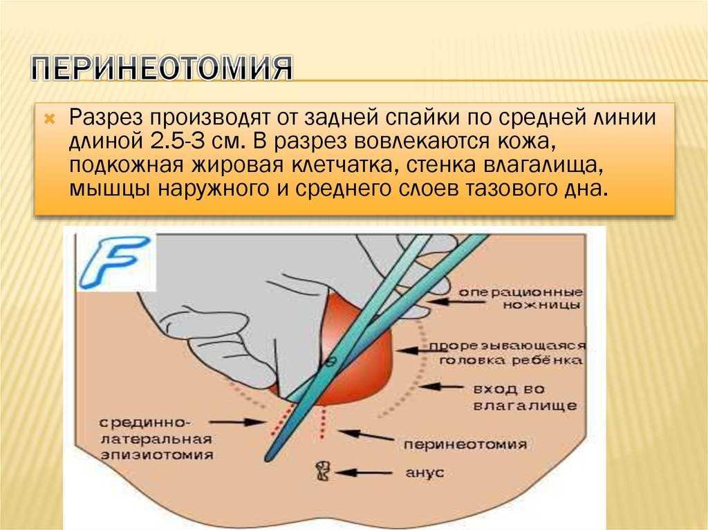 Перинеотомия и эпизиотомия презентация