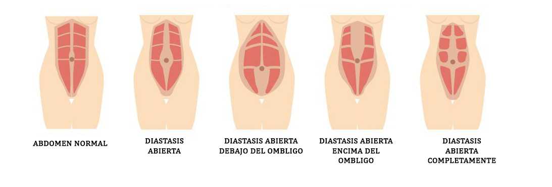 Диастаз после беременности. Норма расхождения мышц диастаз. Диастаз мышц живота 2 степени.