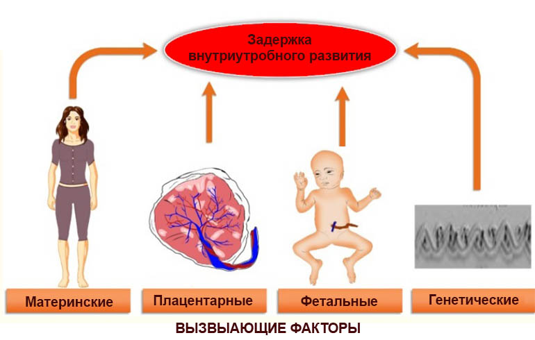 Плод отстает на неделю. Факторы риска рождения ребенка с ЗВУР. Задержка внутриутробного развития. Zaderjka vnutriuteribnogo razvitiya ploda. Синдром задержки внутриутробного развития плода.