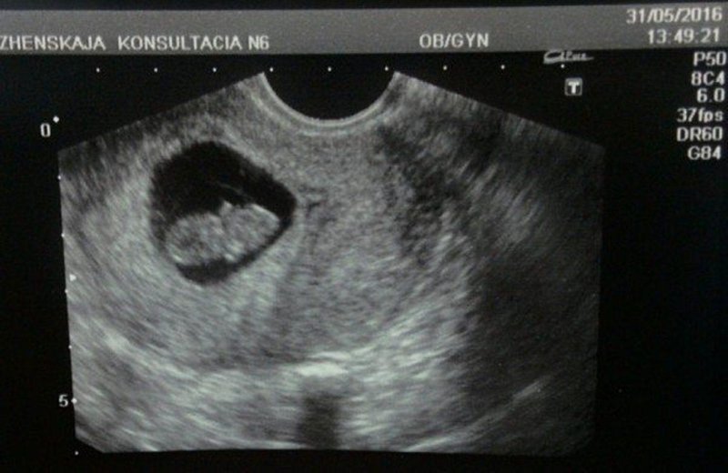 Фото малыша 9 недель беременности