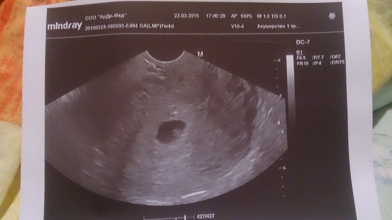 Сколько недель будет сердцебиение. Сердцебиение эмбриона на УЗИ. УЗИ 5-6 недель беременности сердцебиение. Сердцебиение малыша на 6 неделе беременности. На 5 недели беременности УЗИ сердцебиение плода.