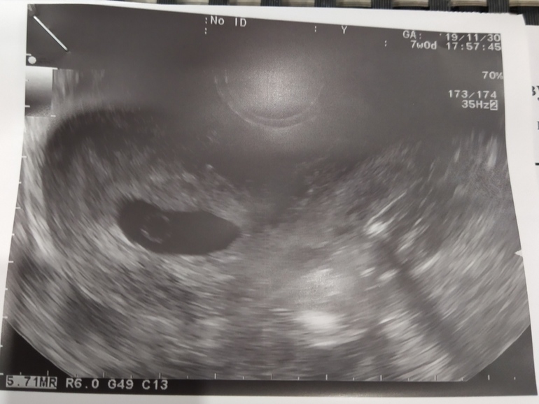 7 недель желточный. Анэмбриония на УЗИ 6 недель. УЗИ анэмбриония 7 недель. Анэмбриония 7 недель беременности.
