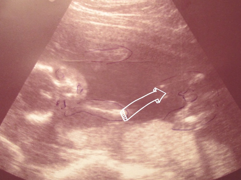 Яички мальчика видео. Мальчик на УЗИ. Половой орган мальчика на УЗИ. Половые органы на 12 неделе беременности.