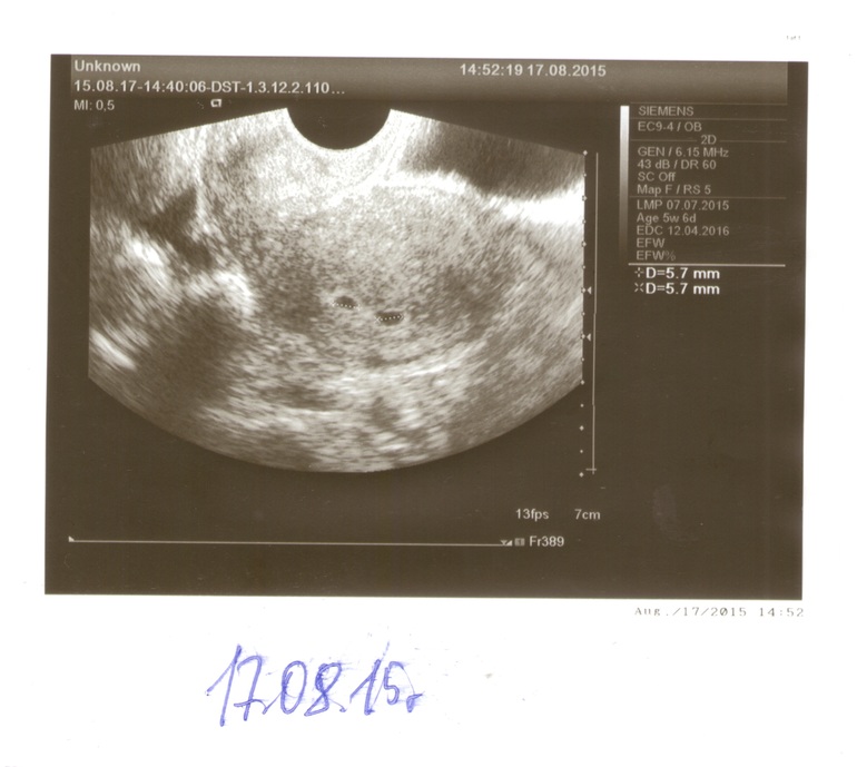 Фото беременности 6 недель 6 дней