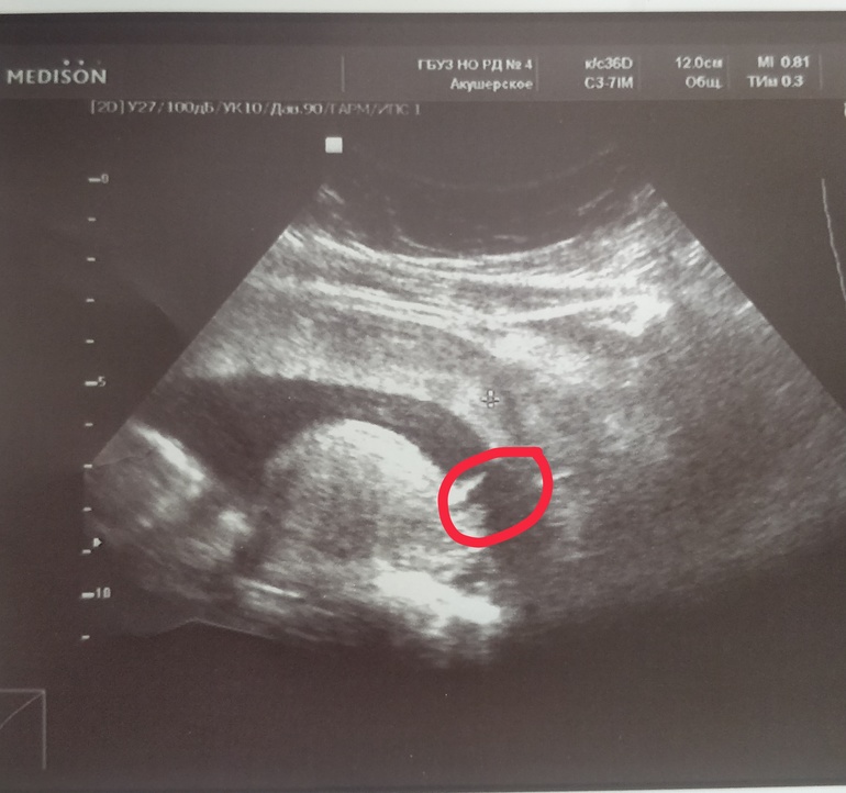 Сердцебиение 14 недель. Плод на 14 неделе беременности. 14-15 Недель беременности.