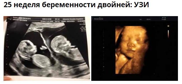 23 недели двойня. УЗИ 24 недели беременности двойней. УЗИ плода на 23 неделе беременности. Снимок УЗИ на 23 неделе беременности. Фото УЗИ двойни на 20 неделе беременности.