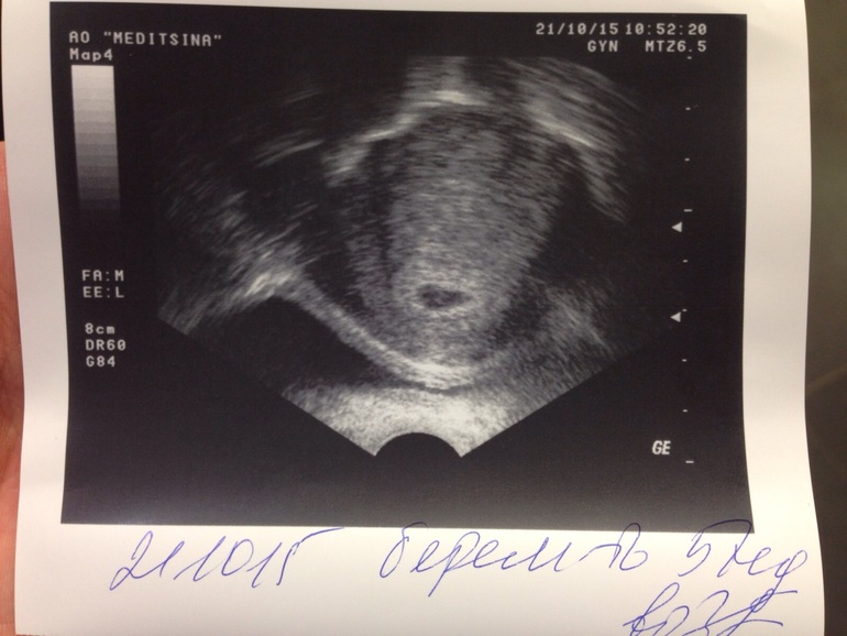 На узи ничего не видно. Плодное яйцо на УЗИ 21дпп. Снимок УЗИ после переноса эмбриона.