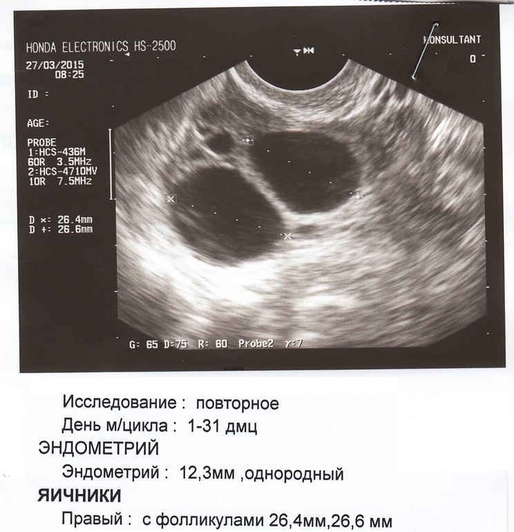Эндометрий норма для зачатия. Доминантный фолликул 21мм. Эндометрий 13 мм фолликул 25 мм. Доминантный фолликул 17 мм на УЗИ. Фолликул 26 мм эндометрий 10 мм.