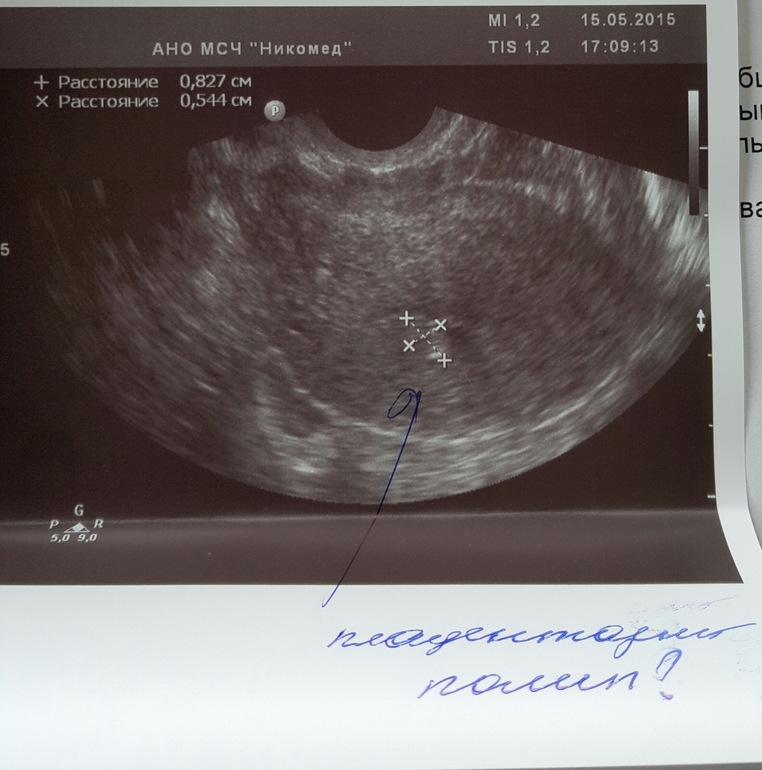 После эндометрия можно забеременеть. УЗИ матки полип эндометрия или беременность. Плацентарный полип на УЗИ.