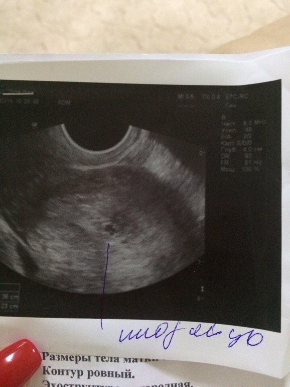 Фото узи при беременности 3 4 недели