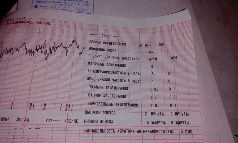 Ктг при схватках фото показатели