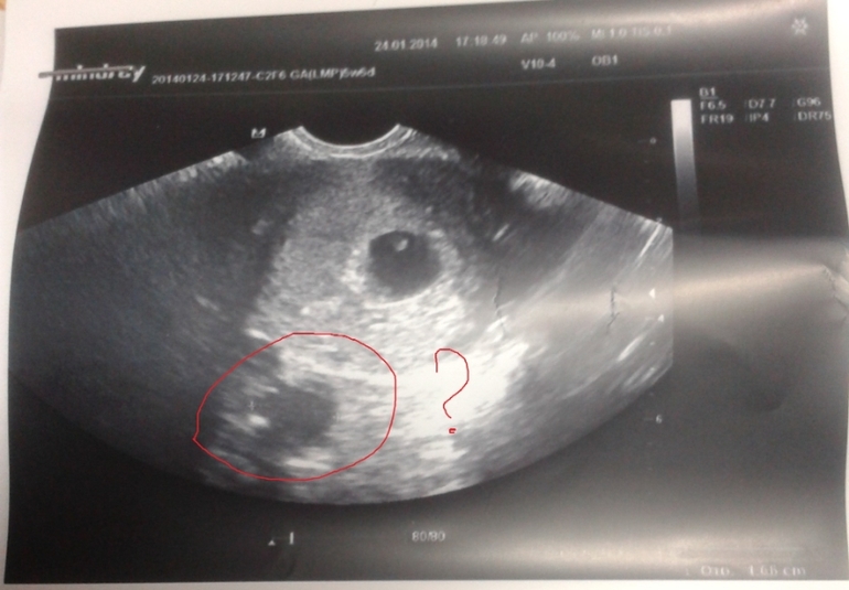 Фото узи беременности 4 недели от момента зачатия