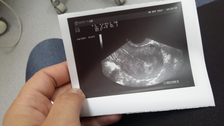 Фото на ранних сроках беременности фото 2 недели
