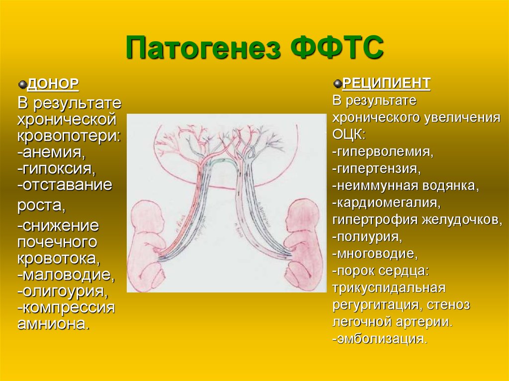 Фето фетальный трансфузионный синдром