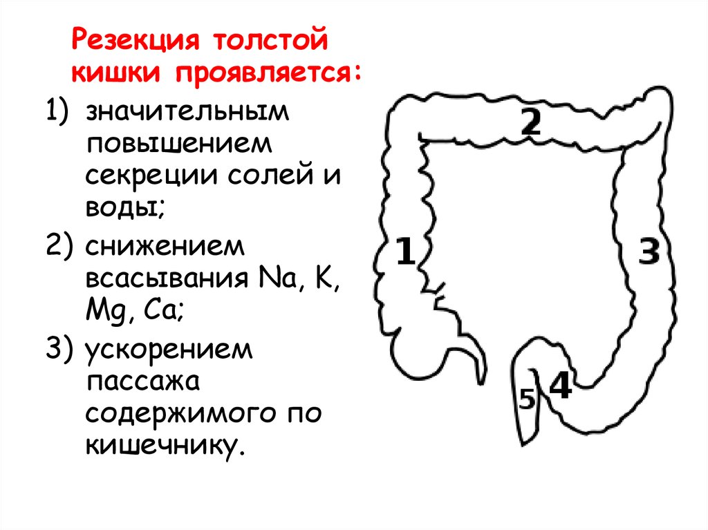 Долихосигма кишечника что это у взрослого симптомы