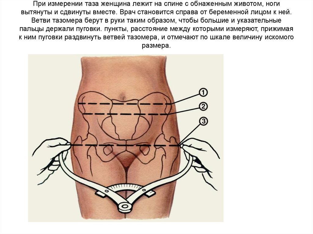 Размеры таза у женщин. Пояснично-крестцовый ромб Михаэлиса. Узкий таз ромб Михаэлиса. Ромб Михаэлиса в акушерстве измерение. Измерение таза женщины.