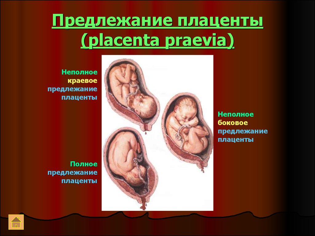 Полное предлежание при беременности. Предлежание плаценты. Краевое предлежание плаценты. Предлежание плаценты головное. Типы предлежания плаценты.