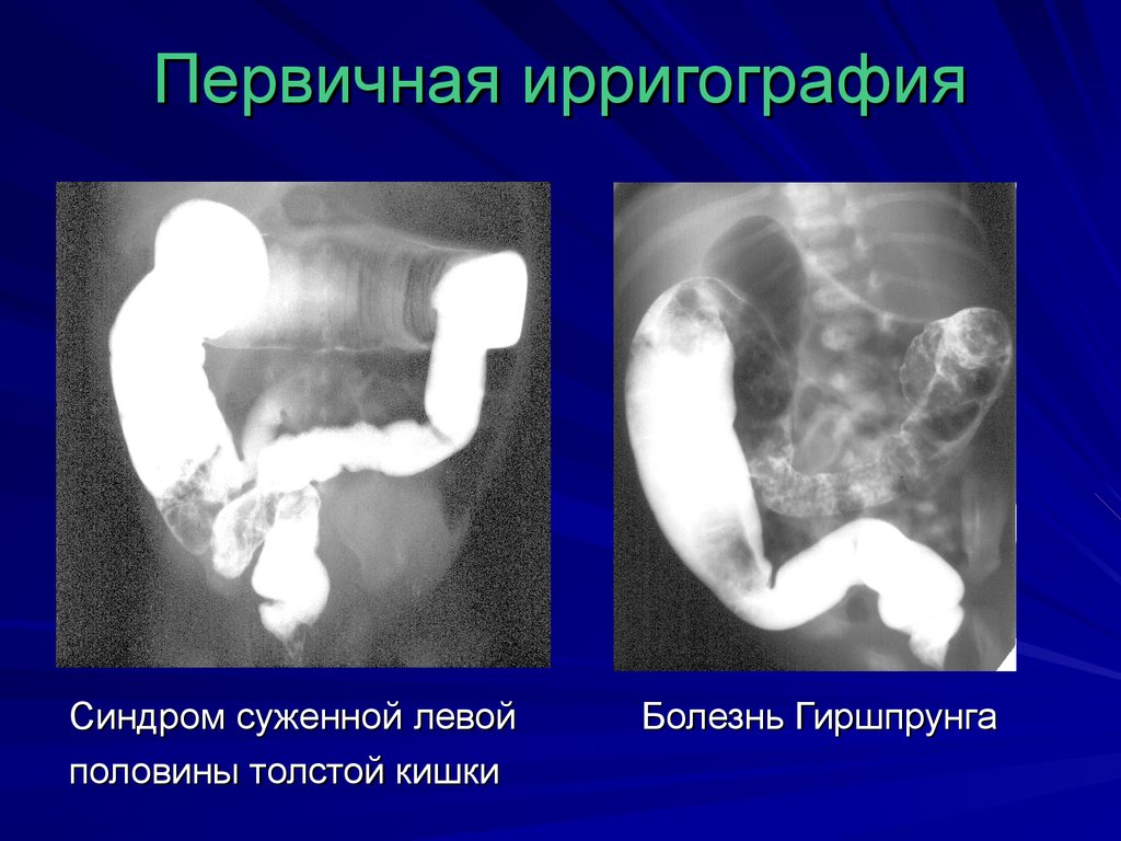 Долихосигма у детей фото