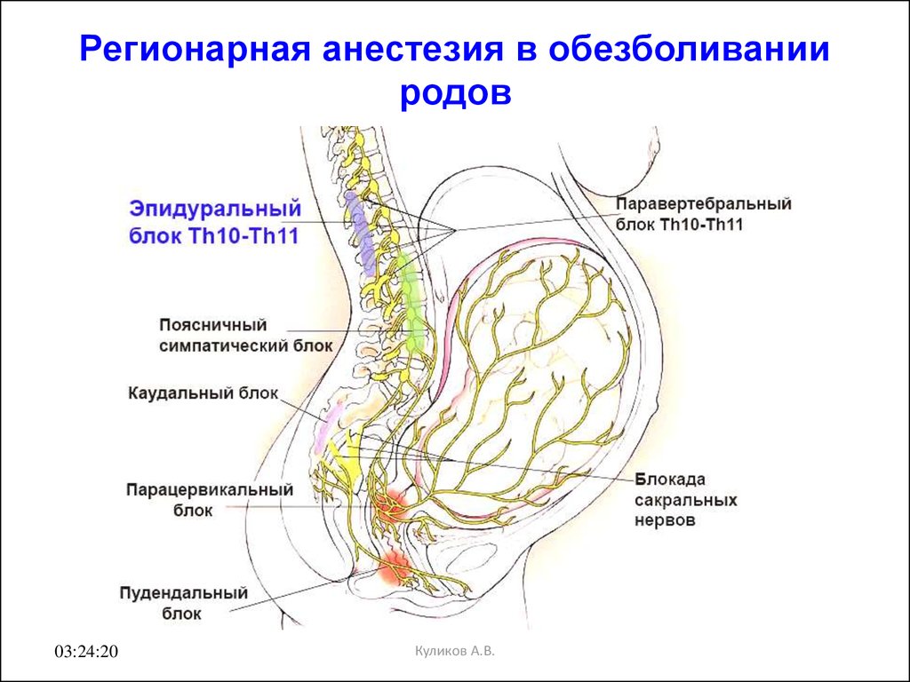 Схема эпидуральной анестезии