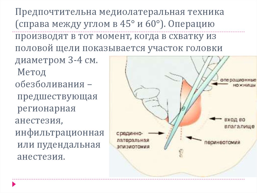 Перинеотомия и эпизиотомия презентация