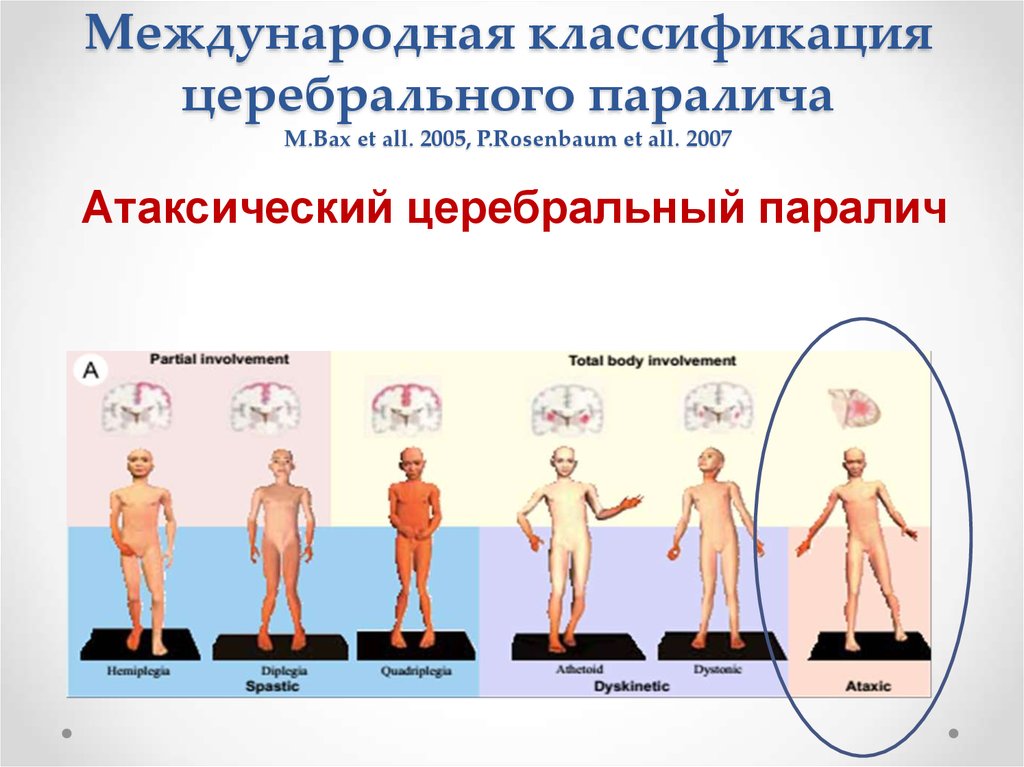 Классификация дцп. Детский церебральный паралич классификация. Атаксический церебральный паралич. ДЦП формы классификация.