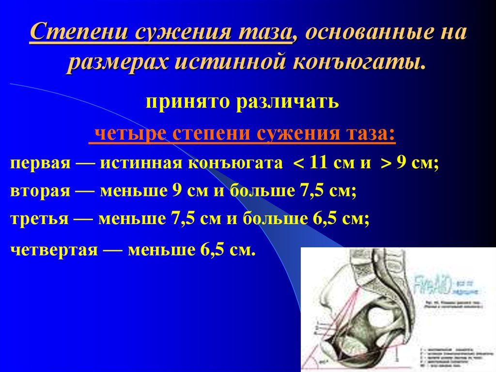 Размеры таза. Истинная конъюгата. Степени сужения таза. Сужение таза 1 степени. Истинная конъюгата степени сужения.