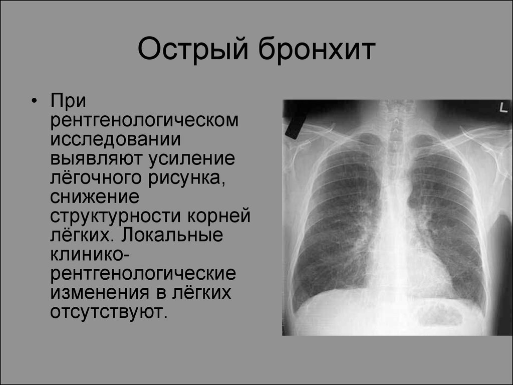 Легочный рисунок усилен на рентгене что это значит у ребенка