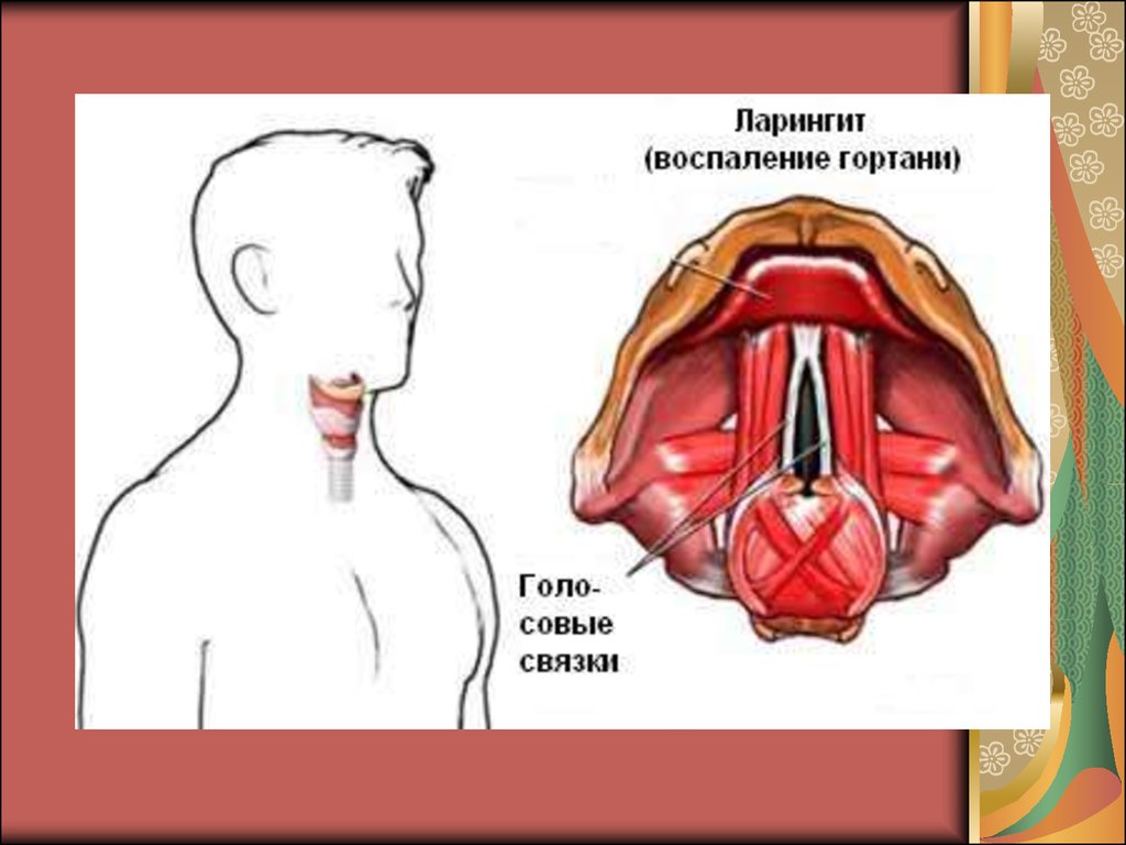 Ларингит лечение у взрослых. Острый катаральный ларингит. Субхондральный ларингит. Воспаление горла ларингит.