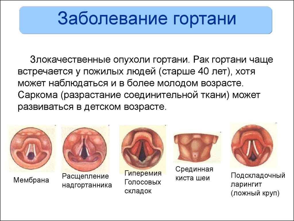 Фарингит карта вызова