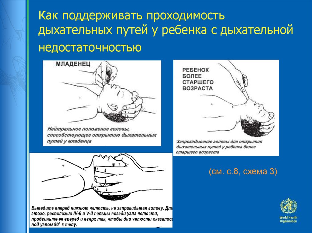 Как обеспечить восстановление дыхательных путей. Методы восстановления проходимости дыхательных путей ребенку. Методы обеспечения проходимости дыхательных путей у детей. Положение головы для обеспечения проходимости дыхательных путей. Восстановление проходимости дыхательных путей у ребенка до года.