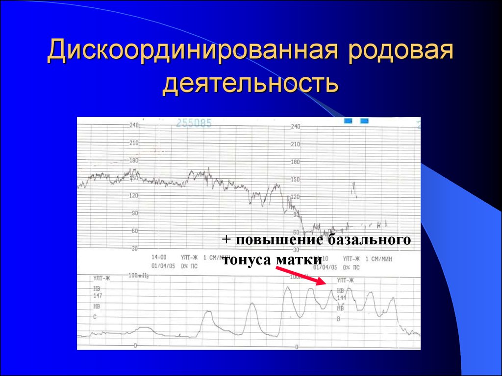 Родовая деятельность. Партограмма дискоординации родовой деятельности. Дискоординация родовой деятельности на КТГ. КТГ при дискоординации родовой деятельности. КТГ при аномалиях родовой деятельности.