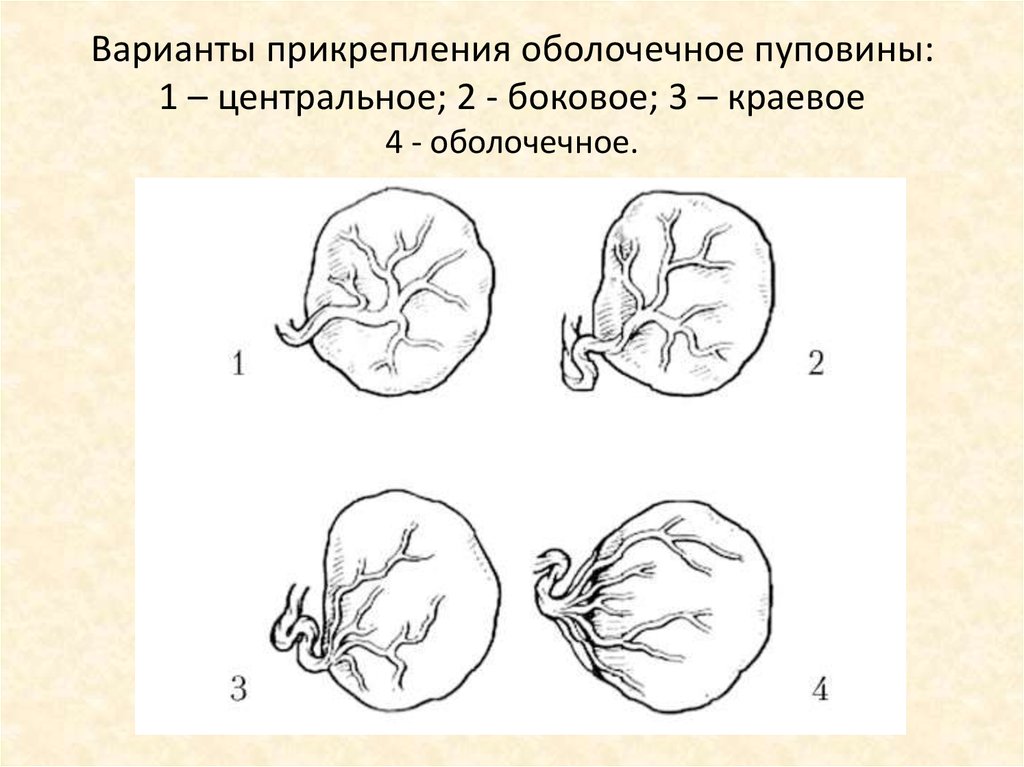 Крупные части плода. Краевое прикрепление сосудов пуповины к плаценте. Оболочечное прикрепление пуповины. Прикрепление пуповины к плаценте центральное. Оболочечное прикрепление пуповины к плаценте.