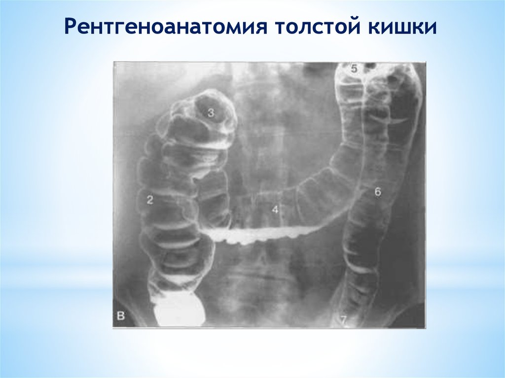 Слепая и ободочная кишка. Ирригоскопия опухоль сигмовидной кишки. Контрастирование Толстого кишечника рентген. Ирригоскопия сигмовидной кишки. Кишечная непроходимость ирригоскопия.