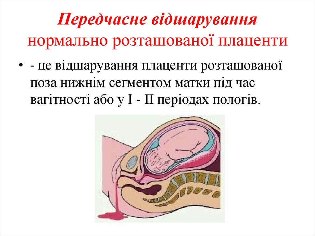 Плацента на ранних сроках. Краевой синус плаценты. Відшарування плаценты. Утолщение краевых синусов плаценты.